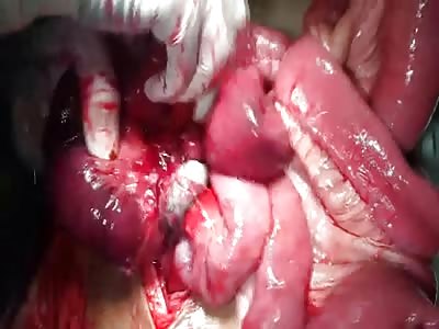 MAN WITH INTESTINAL OBSTRUCTION