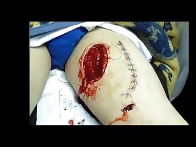 WOUND IN THE LEG