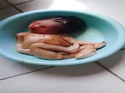 BABY DEAD AT BIRTH