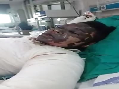 man with burns on face and body