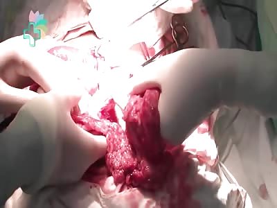 Surgery - Bowel Rupture
