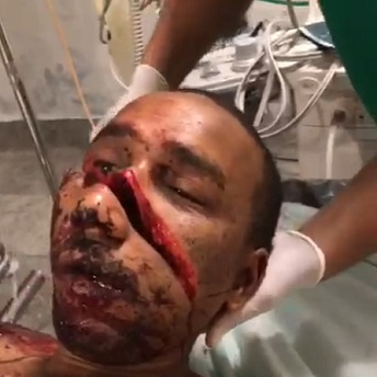 Man Nearly Split In Half After Being Hacked In The Face With Sharp Machete