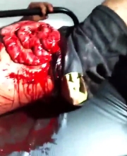 The man's intestines came out after he was stabbed in the stomach