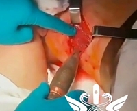 RU POV: Russian Surgeon Pulls out a 30mm Bullet from a Soldier's Left Thigh