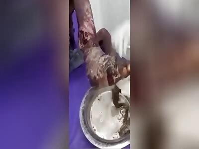 Cleaning maggot ridden foot.