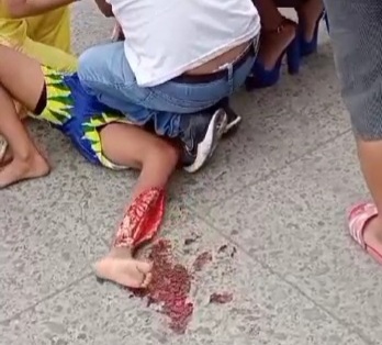 Horrific leg injury of young Ecuadorian man 