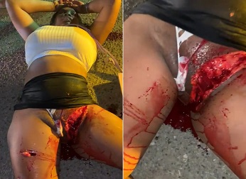 Woman Ends With Two Sexual Organs After Brutal Motorcycle Accident