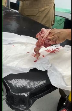 Brazilian man has his hand devoured by a meat grinder