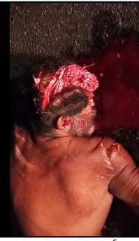 Brazilian man had his head cracked in an accident
