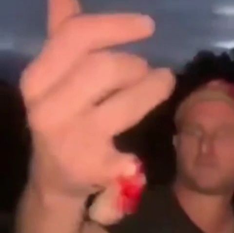 Drunk man cut off his little finger for fun