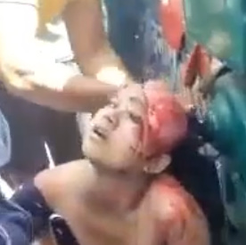 WHOA! Girl Was Horribly Scalped after Crazy Accident