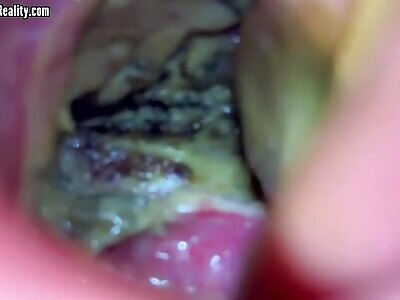 HPV Throat Cancer