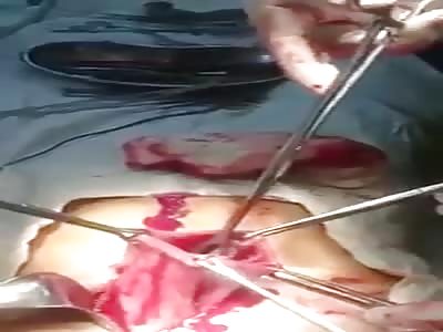 Doctor Removes Toothbrushes Out of the Stomach With the Help of Surgery