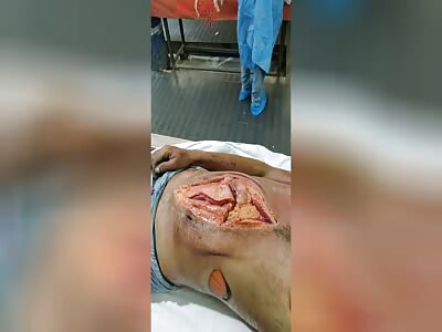 Annotated autopsy of man in first stage of decomposition