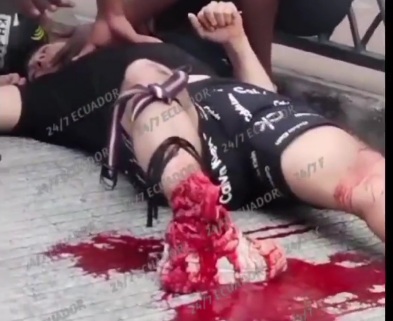 Leg totally destroyed after a traffic accident 