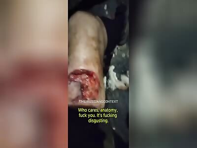  Russian Soldier Studying The Anatomy Of His Leg After Mortar Wound