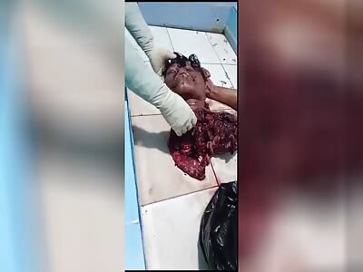 18-year-old falls feet first into  a wood  Chipper.
