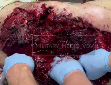 Russian soldier lost the half of his ass due to drone attack 