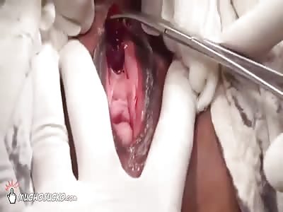 Blob extracted from a woman's urethra