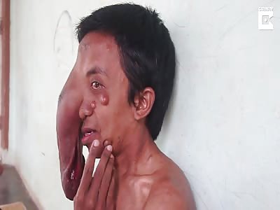 Indonesian Man Has Trunk Like Tumour On His Face