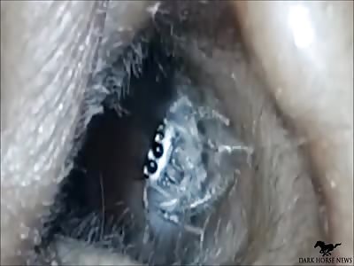 Woman In India Has Spider Removed From Her Ear