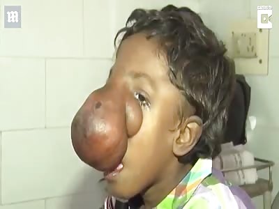 Orphan boy with a trunk like nose awaiting life saving surgery
