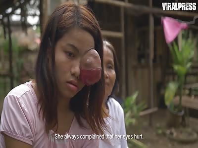 Teenage Girl Battling Eye Tumeur