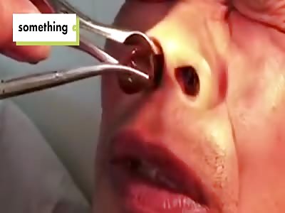 Doctor pulls gigantic leech from manâ€™s nose
