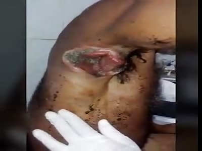 Man with cutting wounds full of worms all overhis body