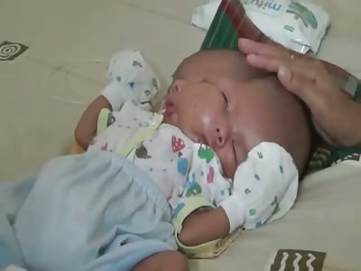 Two headed baby born in Indonesia