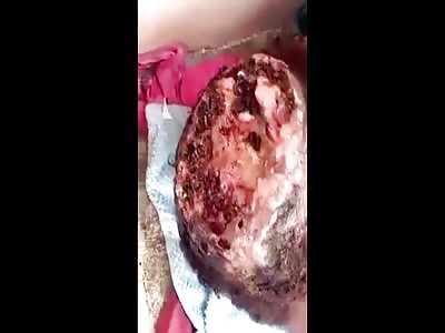 Woman with maggots on her brain