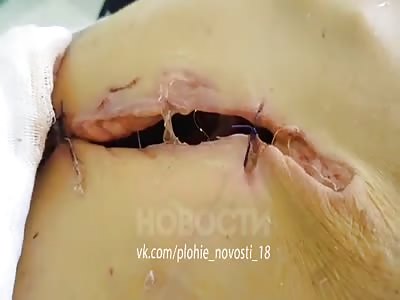 Very ugly  wound in old woman stomach showing organs inside 