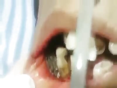 Mouth of disabled boy full of maggots 