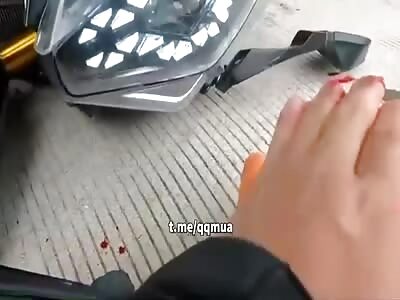 Motorcyclist lost fingers in brutal accident 