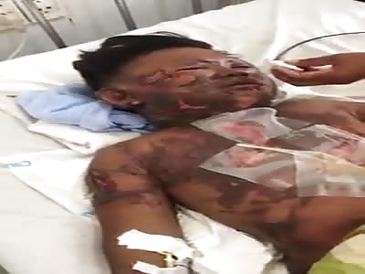 man suffers burns on the whole body