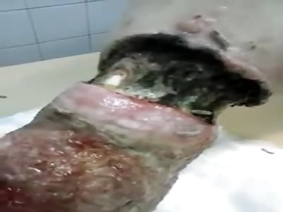 WTF...Man with Severely Infected leg has Maggots Burrowing Inside 