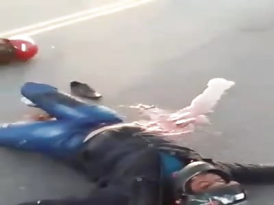 accident leaves the shattered leg of motorcyclist
