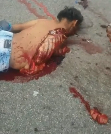 Man has Arm Torn off of Shoulder Blade.(GRAPHIC AFTERMATH)