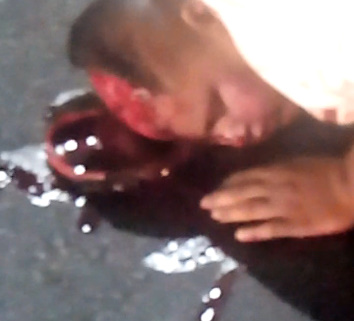 Brazilian Man Partially Scalped in Motorcycle Crash