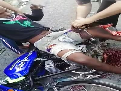 motorcyclist with shattered leg after accident 