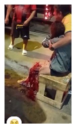 Victim with leg destroyed in horrific accident.