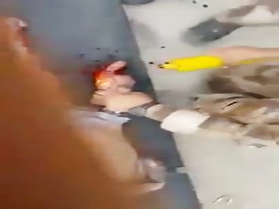 Sad daesh terrorist attack and child loses one leg