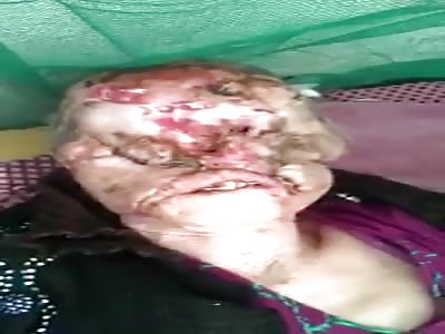 horrible disease on a woman's face