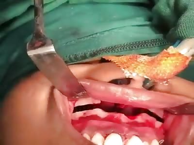 Jaw operation