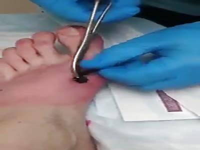 Doctors take out a foot nail