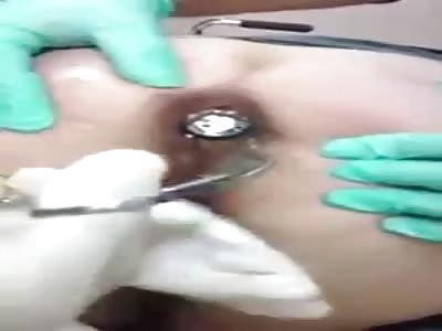 Doctors pull a dildo out