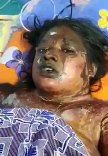 woman in pain after a suicide attempt due to emotional distress from her mother in law in Tamil Nadu