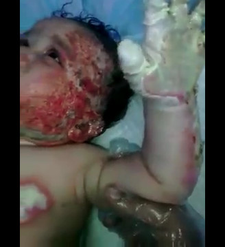 Baby was Burned by his Mother in Iran