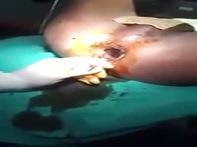 Doctors removing a can of fanta from a boy's asshole