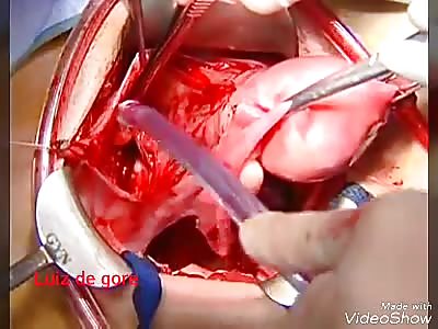 Uterus Removal Surgery-Hysterectomy